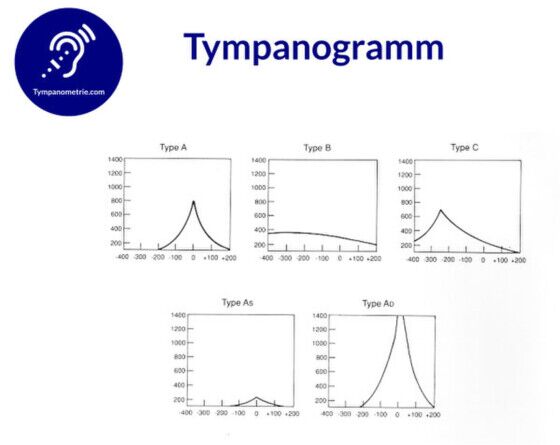 Tympanogramm Typ A B C